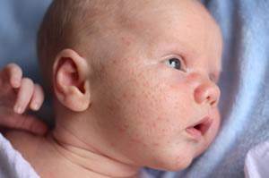 baby acne picture