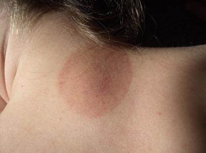 chafing rash on neck