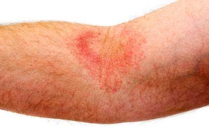 Heat Rash Pictures, Symptoms, Causes, & Treatments