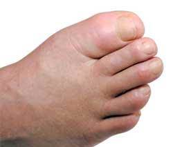 Gout commonly affects the big toe.