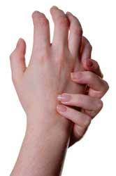 Arthritic Hands