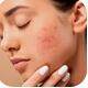 Natural Psoriasis Treatments