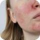 Dermatological Skin Care For Rosacea
