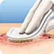 Debrisoft Debridement and Cleansing